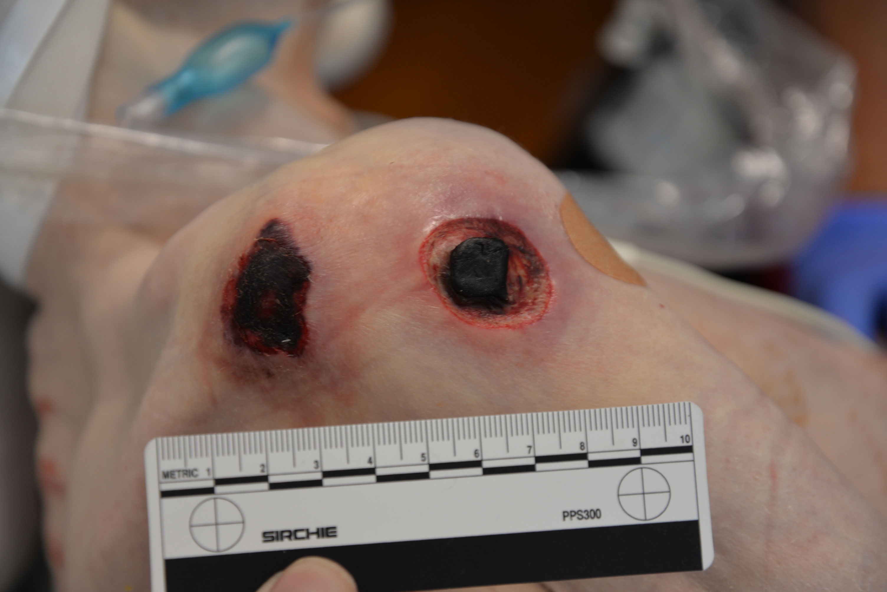 Figure 2 A close-up photo of Aaron’s right shoulder reveals two severe pressure sores. Someone is holding a black and white ruler to measure the diameter of the wounds. The smaller sore, on the outside of Aaron’s shoulder, measures approximately 2 cm in diameter and the interior scab is approximately .75 cm deep. The bone under this wound may be infected; layers of tissue are missing and the scab is recessed from the wound’s edges. The other pressure sore, on the back of Aaron’s shoulder, is wider. The skin around both wounds is light purple. Aaron wears a band aid on the front of his shoulder.