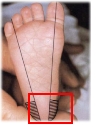 demonstration of proper heelstick screening location on a baby's foot