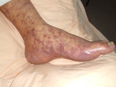 Advanced late-stage rash in an RMSF patient. Photo: Centers for Disease Control and Prevention.