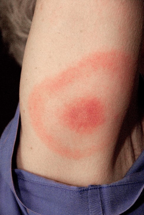 Erythema migrans rash. Photo: James Gathany, Centers for Disease Control and Prevention.