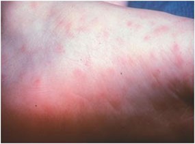 Early-stage rash in an RMSF patient. Photo: Centers for Disease Control and Prevention.