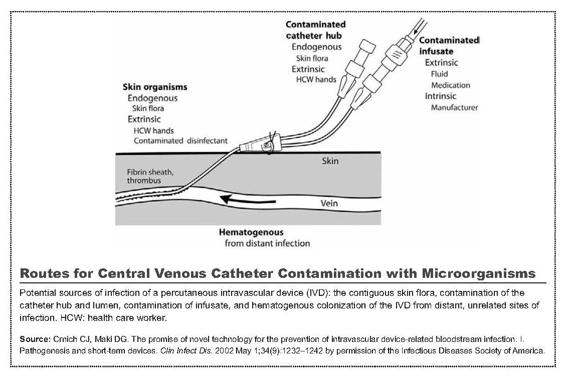 Routes for Central Venous Catheter Contamination with Microorganisms