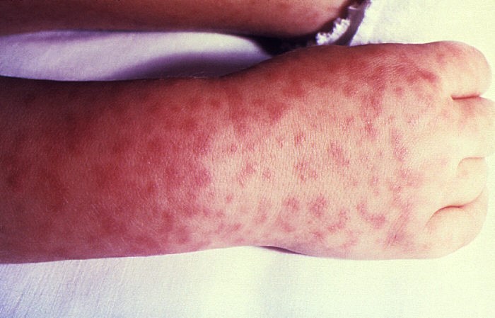 Late-stage rash in an RMSF patient. Photo: Centers for Disease Control and Prevention.
