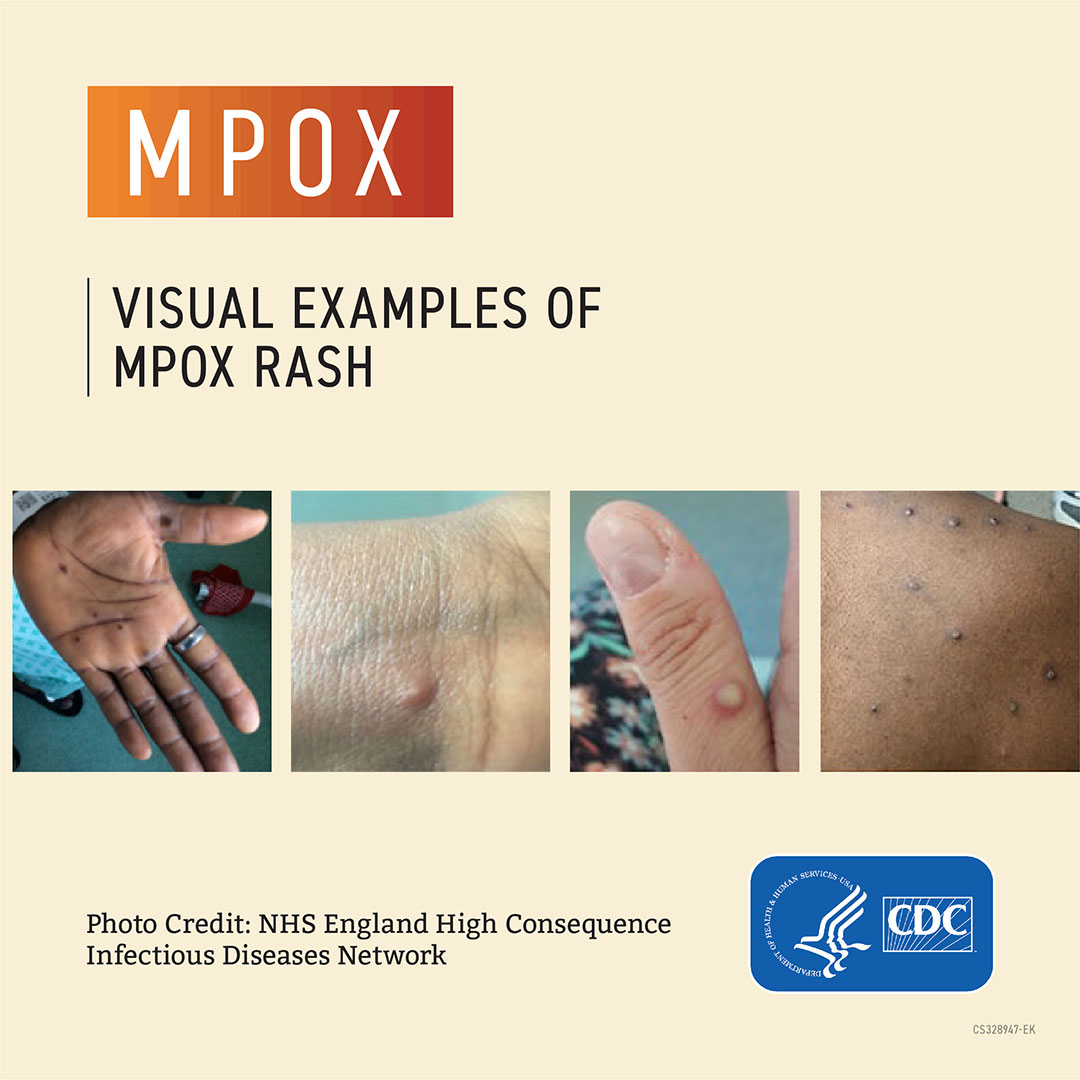 mpox