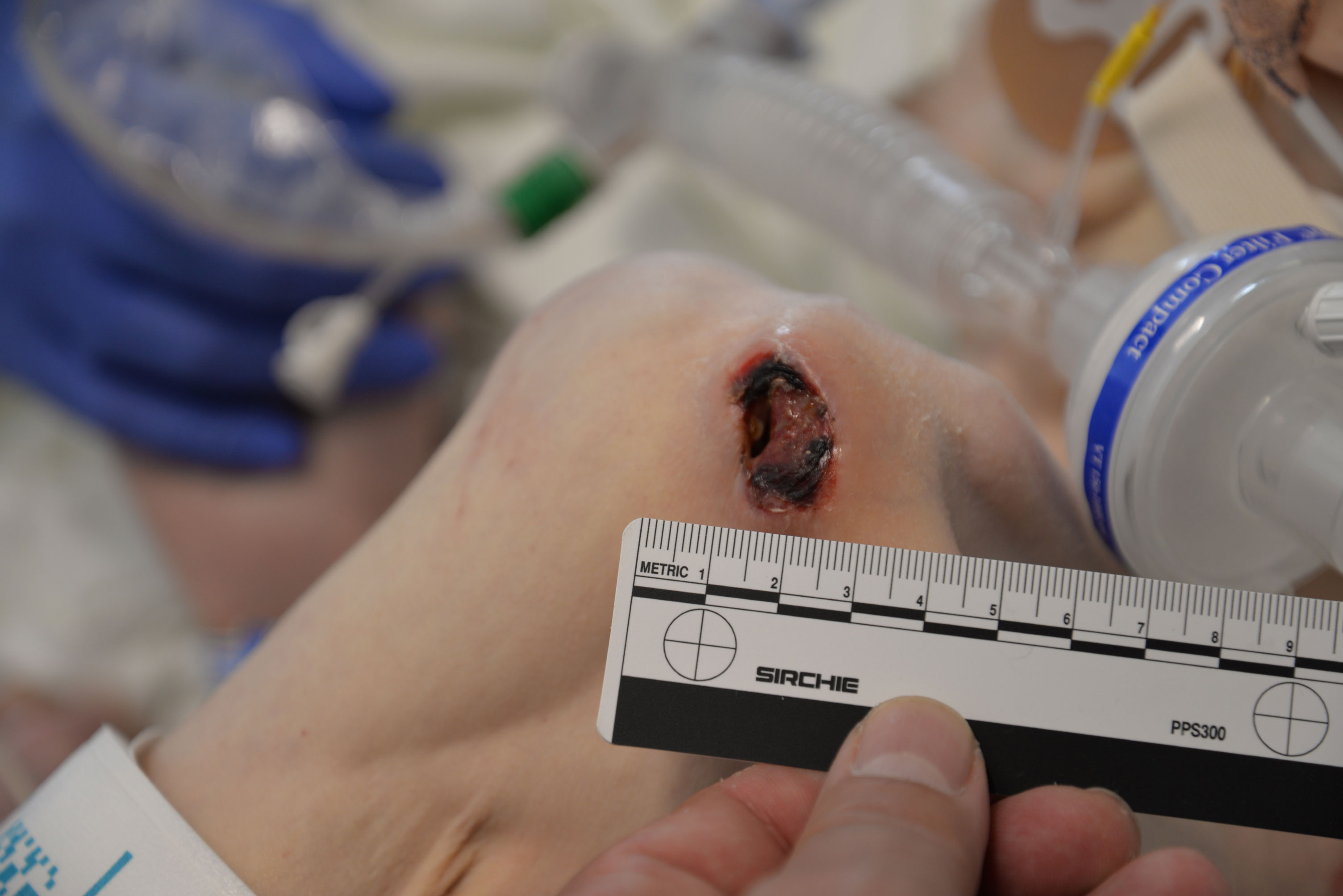The foreground depicts a black-and-white ruler to the left of Aaron’s knee. The wound appears to be 2 cm in height and larger in width. The sore has mostly scabbed over, but for the center. Aaron’s kneecap is outlined against his pale skin and emaciated frame. Blue and white medical tubing is visible in the background. 